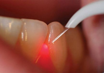 лечение лазером кисты зуба