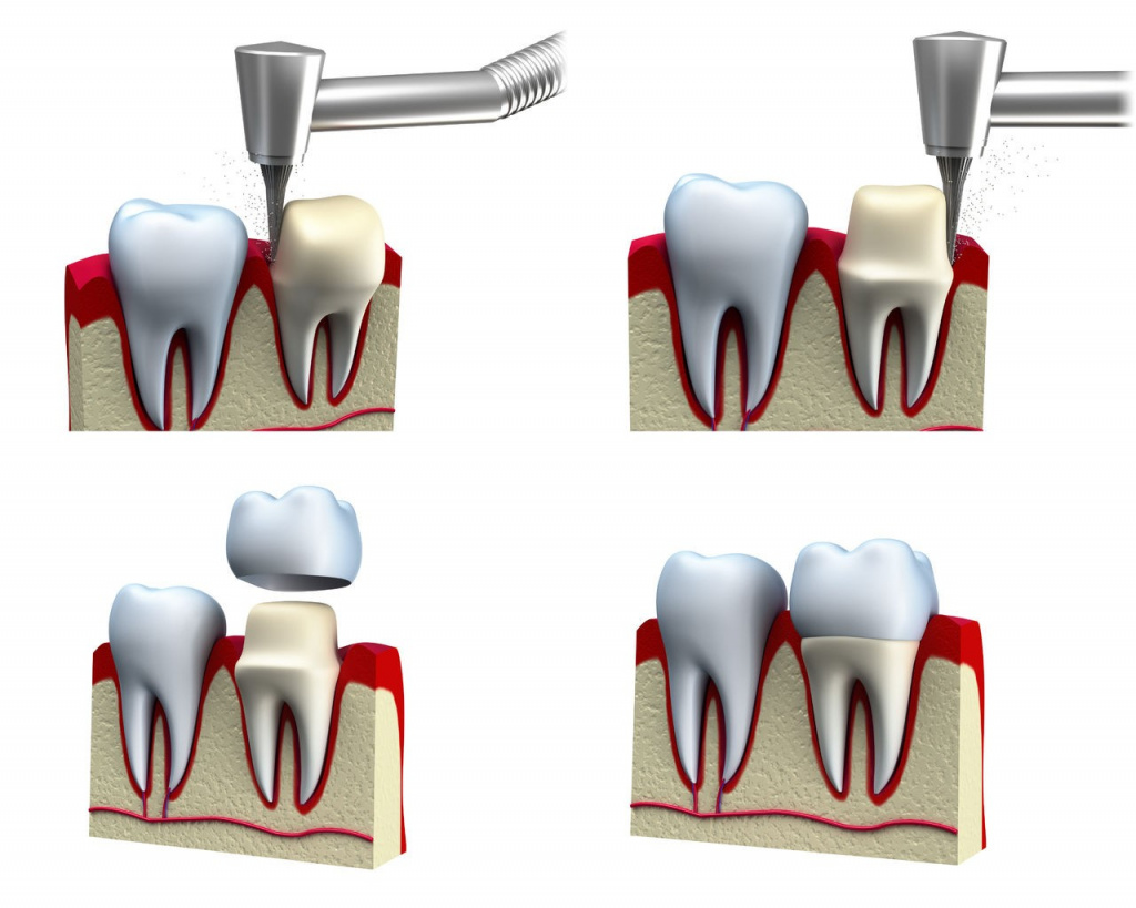 Способы наращивания зубов